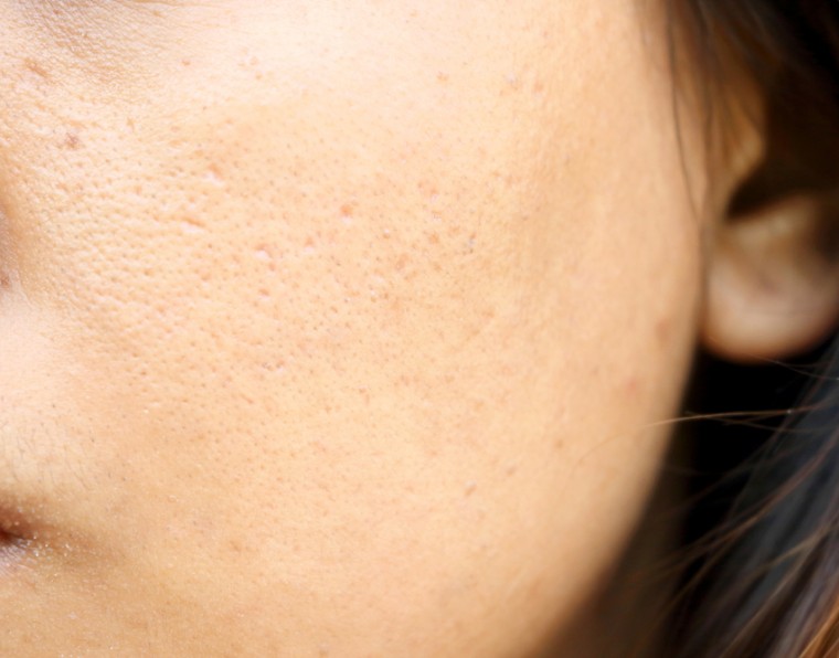 Redução de poros: 3 dicas para oferecer tratamentos | ADCOS Profissional