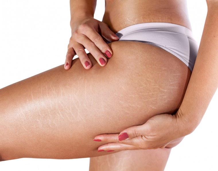 Entenda os tipos de estrias e como oferecer tratamento | ADCOS Profissional