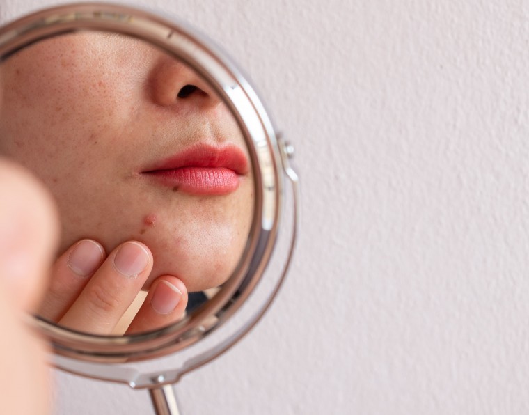 acne adulta tratamento