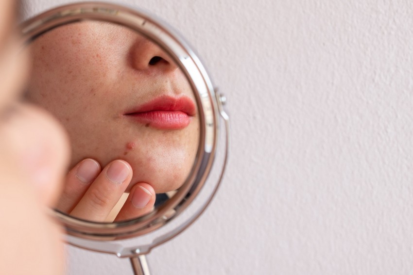 acne adulta tratamento