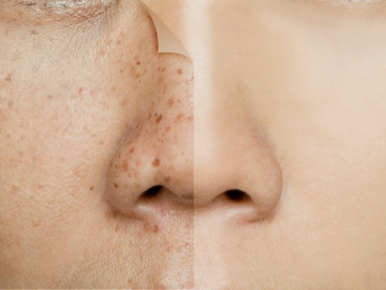 Rosto de pessoa com manchas escuras na pele