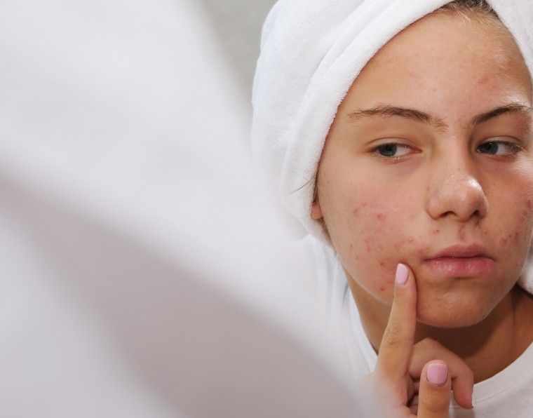 adcos profissional - Principais problemas de pele adolescentes