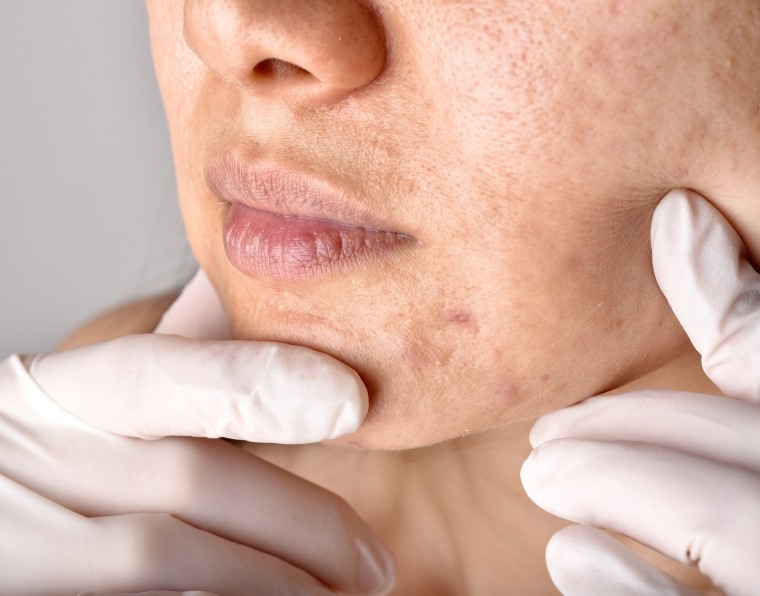 manchas e melasma _ adcos profissional