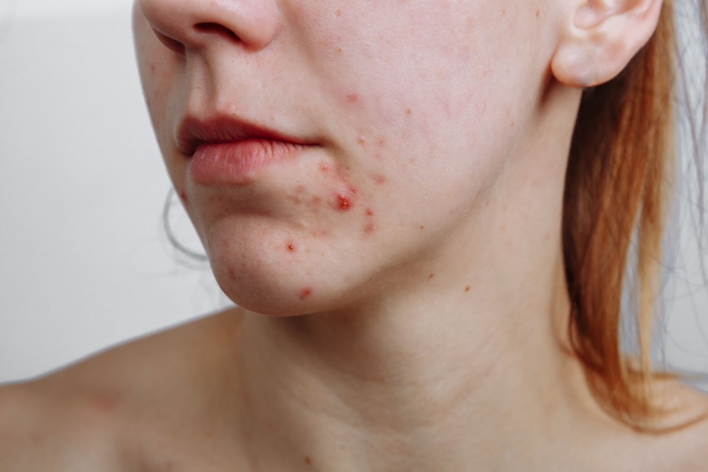 adcos_cicatriz de acne