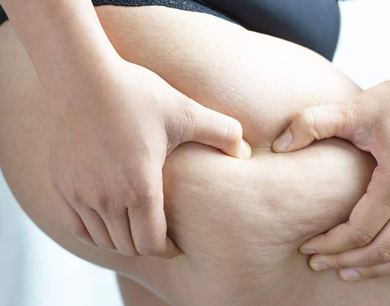 tratamento de lipedema