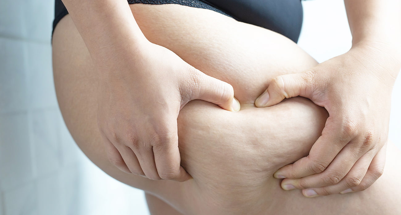 tratamento de lipedema